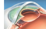 Cataract - clear plastic artificial lens