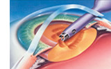 Cataract Ultrasound Probe